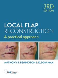 健康・医学 Local Flaps in Facial Reconstruction Local Flaps in Facial Reconstruction | ScienceDirect